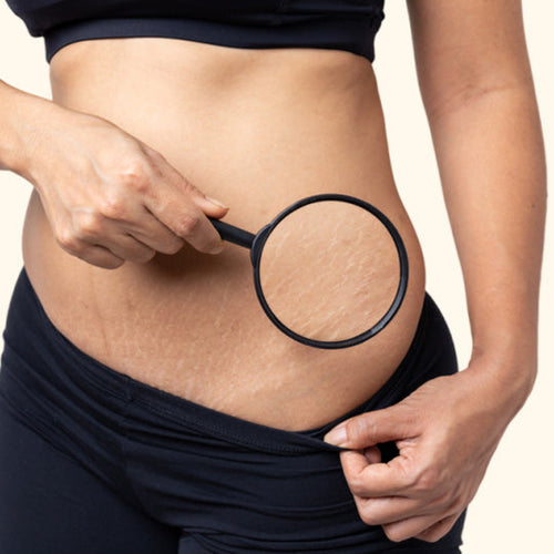 Anti Stretch Marks Herbal Extract Blend